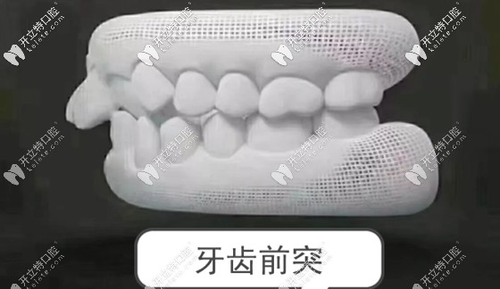 牙齿前突也叫做龅牙