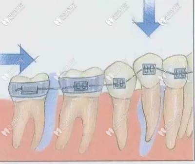 牙齿矫正的过程就是牙根在移动