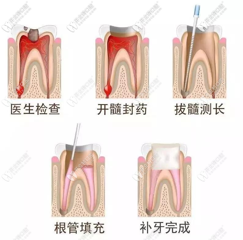 牙髓炎治疗方法