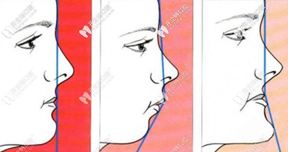 是否需要做正颌取决于多种因素 是否需要做正颌取决于多种因素