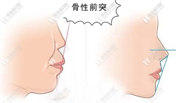 良心医生不建议盲目做正颌 良心医生不建议盲目做正颌