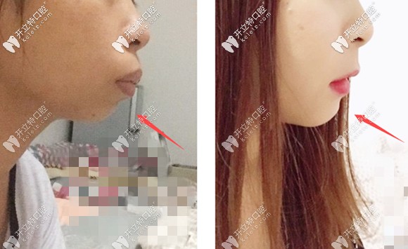 成功的正畸正颌联合治疗效果 成功的正畸正颌联合治疗效果