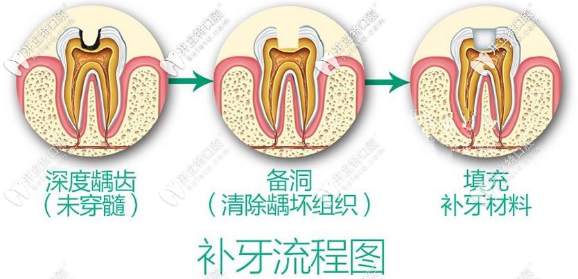 补牙攻略：3m和德国voco纳米树脂补牙哪个材料更好？
