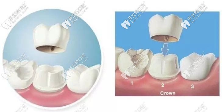 柏乐口腔钴铬牙冠 柏乐口腔钴铬牙冠