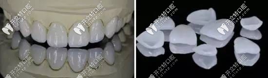 柏乐口腔全瓷牙齿贴面 柏乐口腔全瓷牙齿贴面