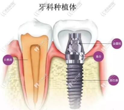 牙科种植体