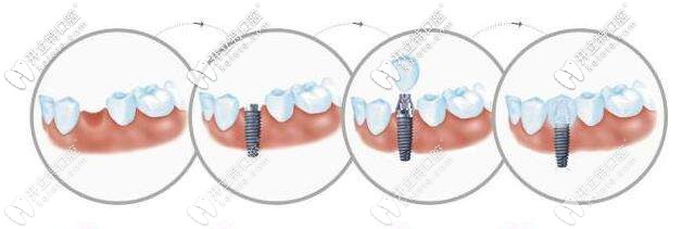百康种植牙过程