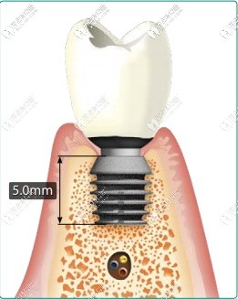 百康种植体的长度更短