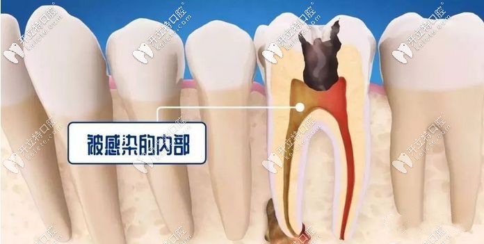开髓引流术牙神经不在了不信你看这牙齿开髓引流步骤图