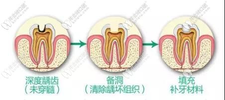 牙齿龋洞较深要做根管治疗