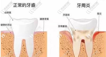 正常牙齿与牙周炎的对比图