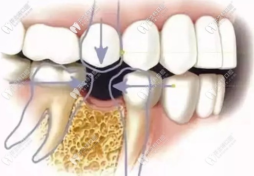 缺一颗牙可诱发多种口腔疾病