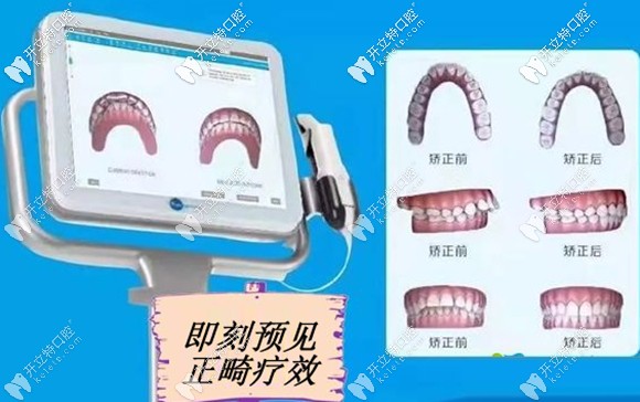 在美奥矫正牙齿几分钟即刻预见矫正效果