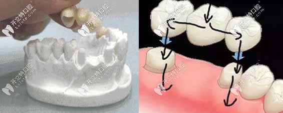 全瓷牙和烤瓷牙冠修复牙齿缺失