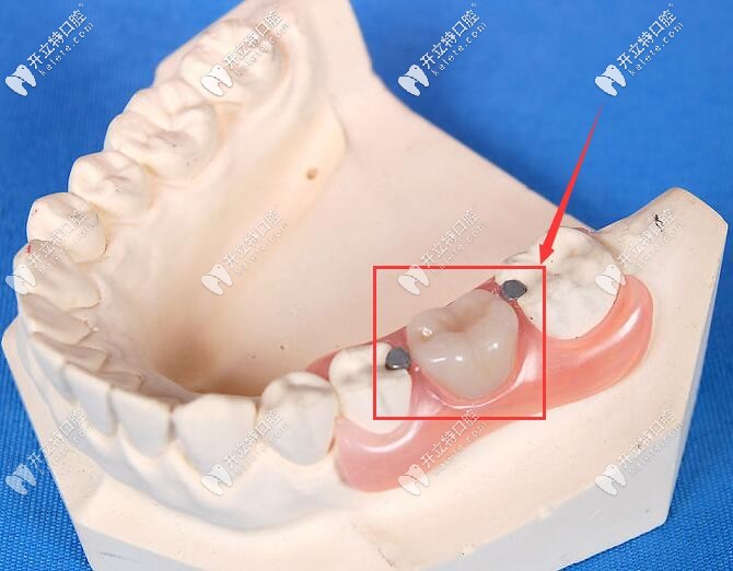 活动假牙修复单颗牙缺失
