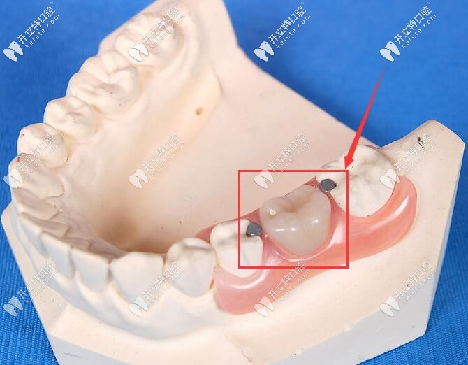 一颗牙活动义齿图片图片