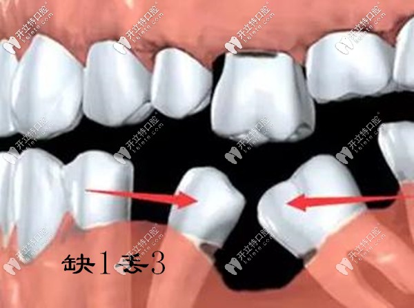 缺一颗牙齿不管就会掉3颗