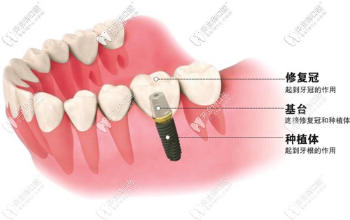 别迷糊,种植牙的原装成品基台和个性化定制基台区别在这