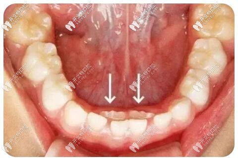 乳牙滞留双排牙
