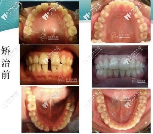 北京劲松口腔时代天使牙套案例