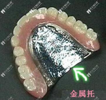 金属活动义齿 金属活动义齿
