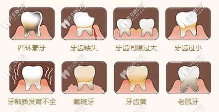 适合做牙齿贴面的牙齿情况 适合做牙齿贴面的牙齿情况
