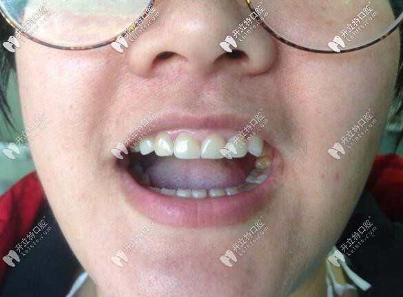 唐山诚品口腔牙贴面真人案例
