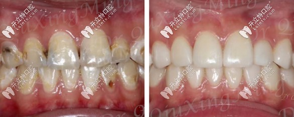 二氧化锆全瓷牙贴面修复前后对比图