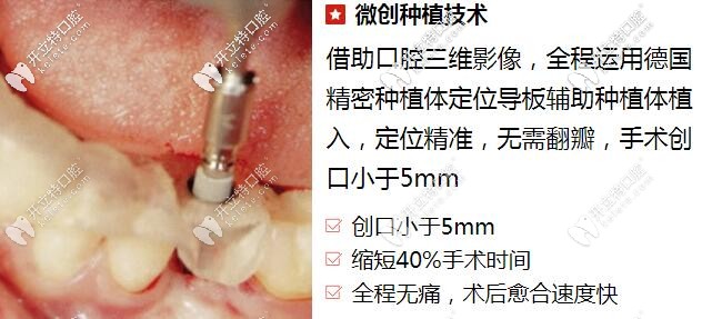 贵阳柏德口腔微创种植牙技术