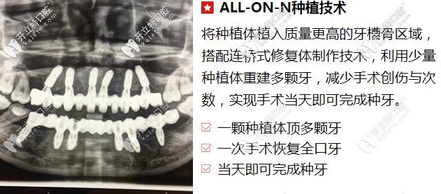 贵阳柏德口腔allon4种植牙技术