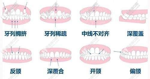 8种情况需要矫正牙齿