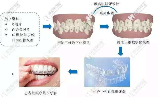 隐形牙套矫正的流程 隐形牙套矫正的流程