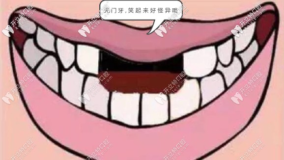 门牙为什么要选即拔即种?可借鉴我的门牙种植经历哈