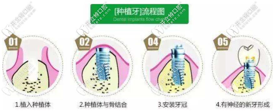 种植牙流程