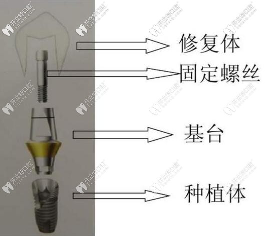 种植牙组成