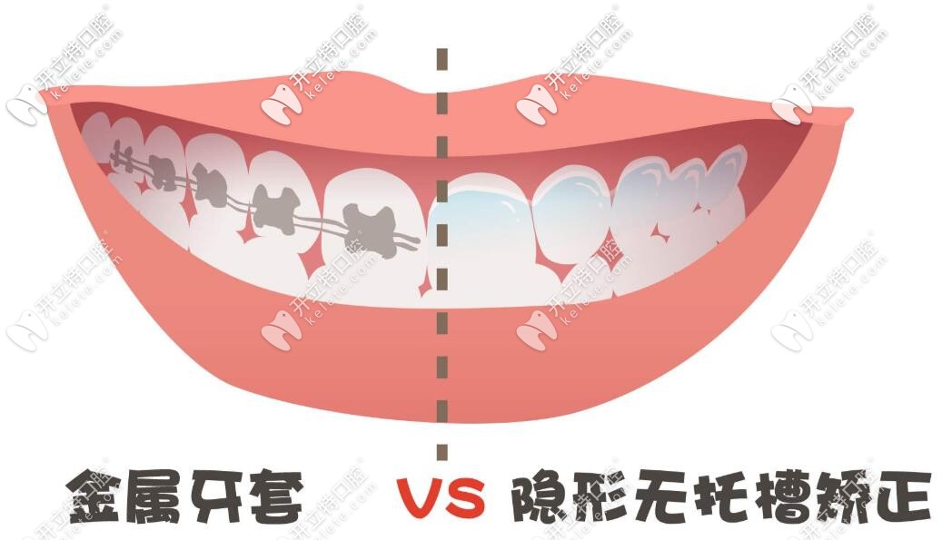 钢牙和隐形矫正 钢牙和隐形矫正