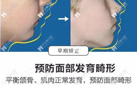 小孩子早期干预矫正的好处 小孩子早期干预矫正的好处
