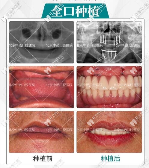 北京中诺口腔全口种植牙真人案例