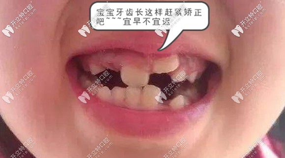孩子牙齿错颌不齐真人效果图 孩子牙齿错颌不齐真人效果图