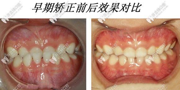 早期干预矫正的效果图对比 早期干预矫正的效果图对比
