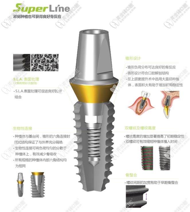 登腾superline种植体型号