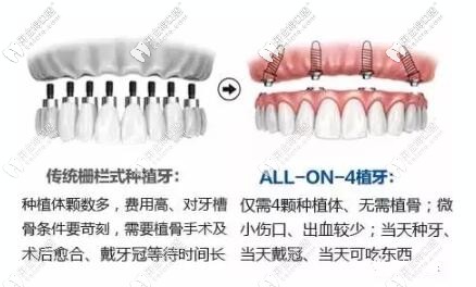  All-on-4种植牙