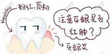 矫正时要注意牙龈是否红肿 矫正时要注意牙龈是否红肿