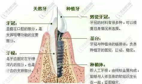 种植牙的组成部分及用途