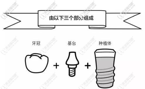 种植牙如何选择种植体的型号和规格？原来学问那么大!