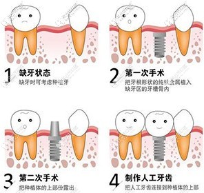 做种植牙的过程图