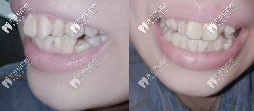 缩短每副牙套的周期同时增加附件
