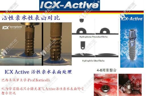 ICX种植体的表面处理技术 ICX种植体的表面处理技术