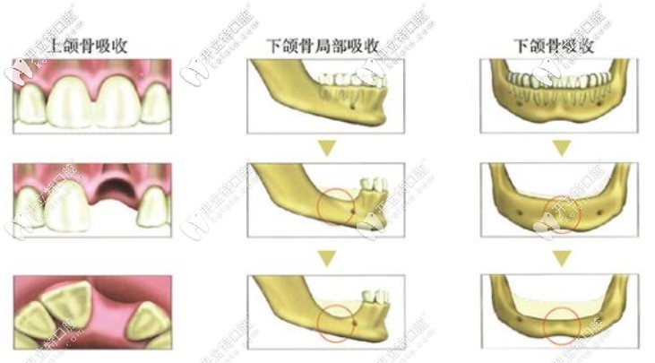 瑞锆亲水种植体可以避免植骨手术