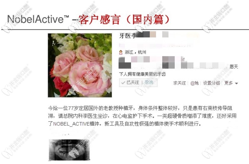 瑞典nobel种植体active医生使用后反馈